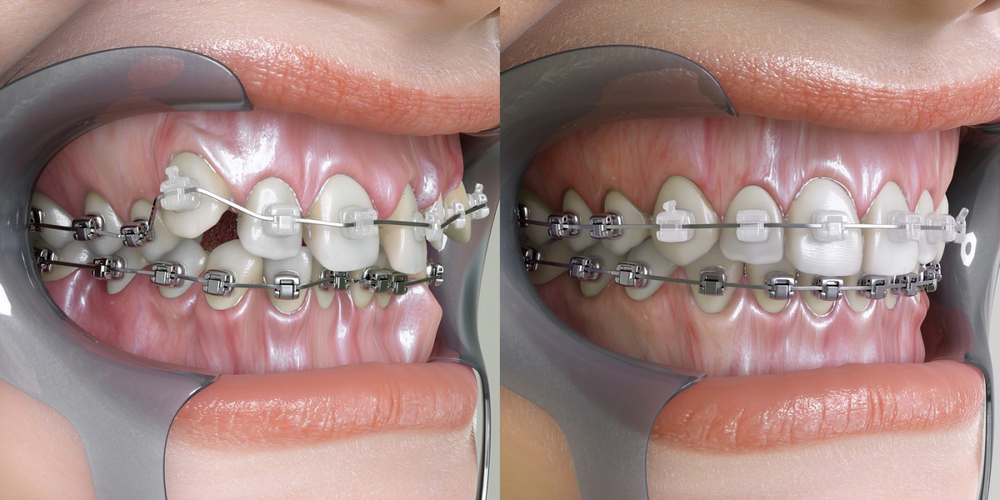 Cum functioneaza aparatul dentar