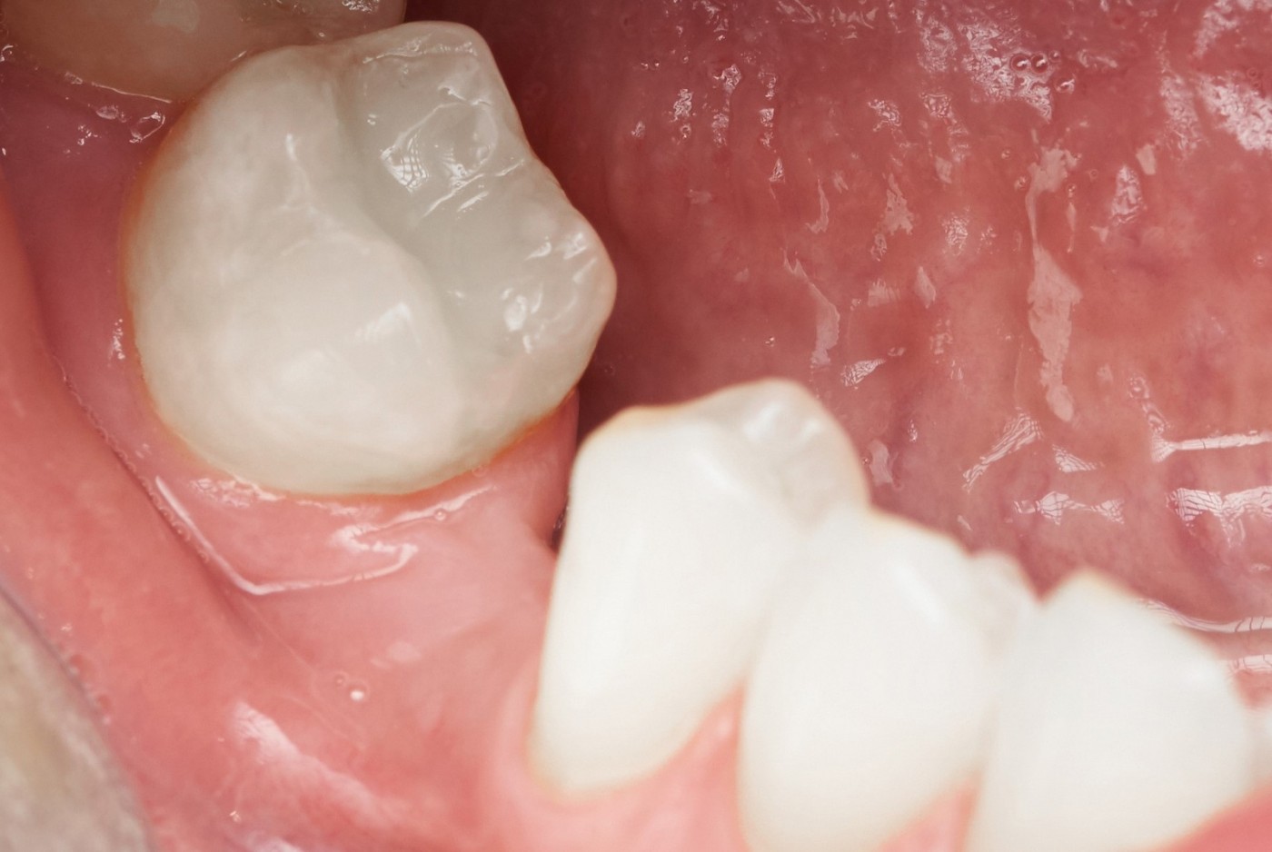 Ce se poate întâmpla dacă nu urmezi tratamentul prin implant dentar recomandat ca cea mai bună opțiu