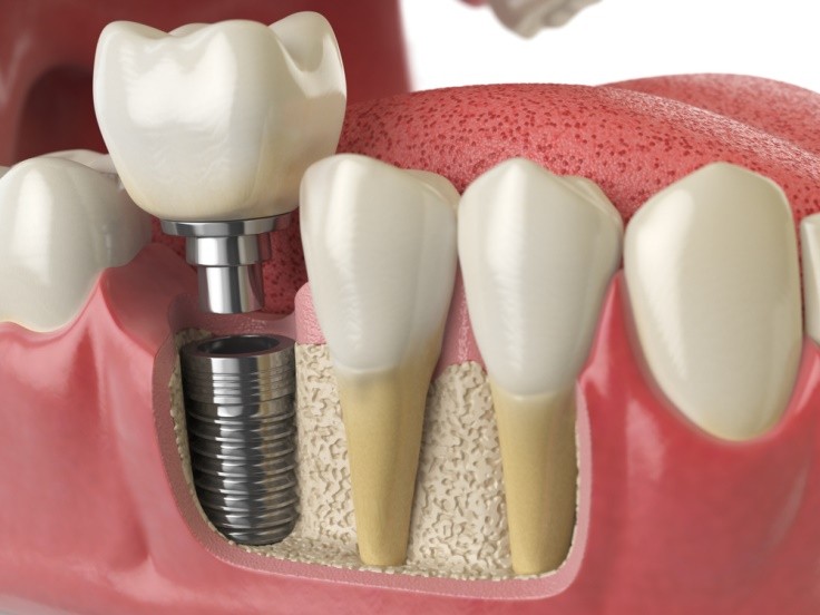 Punte dentara sau implant dentar