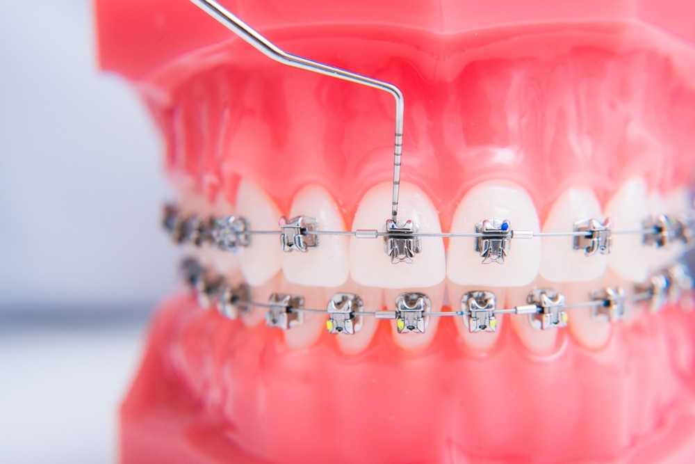 ortodontie braila, aparat dentar braila